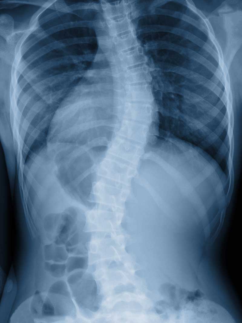 Scoliosis 5330 S 900 E Ste 175<br />Millcreek, UT 84117